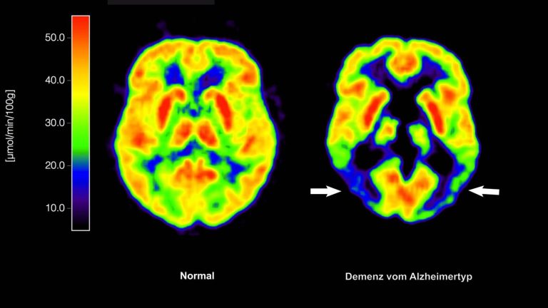 Gesundheit: Antikörper Lecanemab: Wie er wirkt und wem er helfen kann